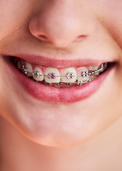 A girl with traditional braces