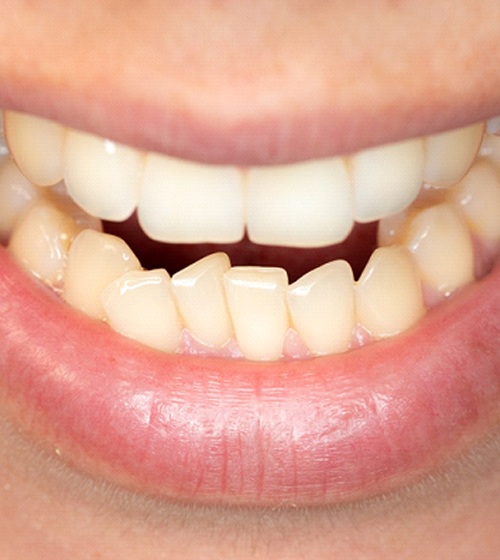 An up-close look at a person’s overcrowded teeth