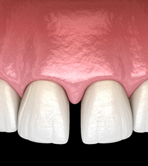 A digital image of an unwanted gap between the two upper front teeth