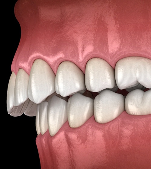 A digital image of an overbite with the top teeth protruding out over the bottom teeth