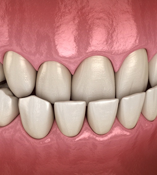 A digital image of an underbite with the top teeth sitting further back than the lower teeth