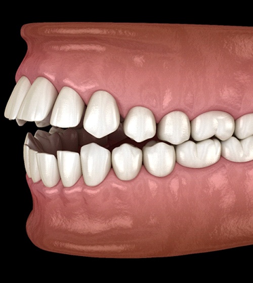 A digital image of an open bite with the back teeth touching but not the front teeth