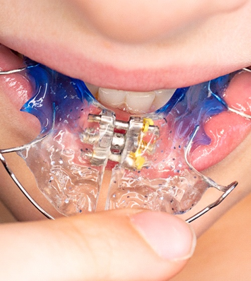 A young patient holding an anterior biteplate in Plano