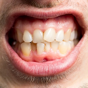 closeup of man with crowded teeth