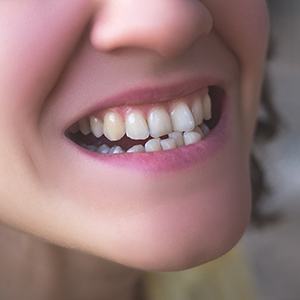 closeup of dental crowding 