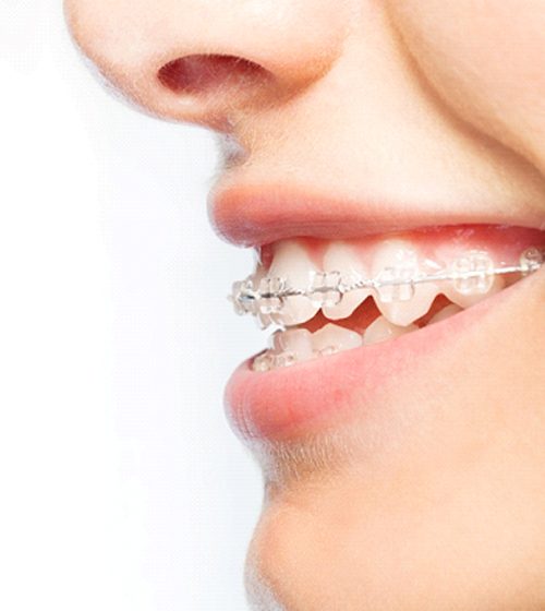 A profile view of an individual wearing clear ceramic braces