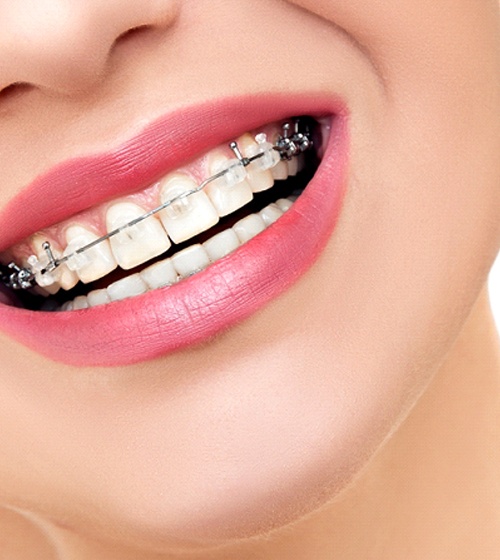 An up-close view of a person’s mouth that contains self-ligating braces