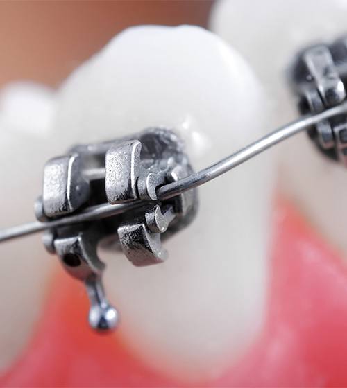 Closeup of teeth with self ligating braces in place