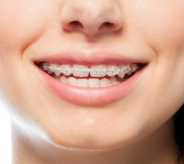 Closeup of smile with clear and ceramic braces