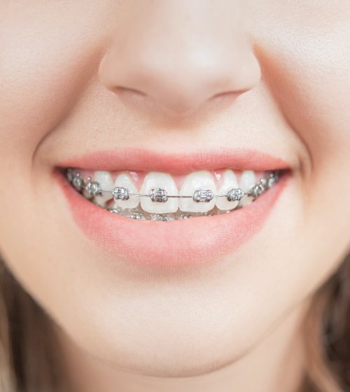 Closeup of smile with customizable brackets