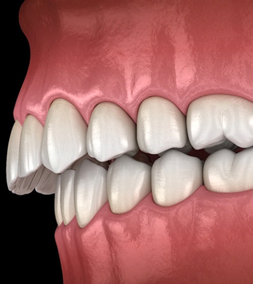 A digital image of an overbite where the upper teeth protrude out further and the lower teeth sit inside the upper arch
