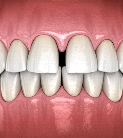 A digital image showing a major gap between the upper front two teeth