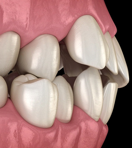 A digital image of teeth that are severely crooked