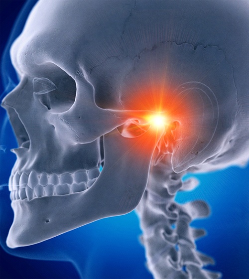 A digital image of a skeleton and pain radiating from the temporomandibular joint 