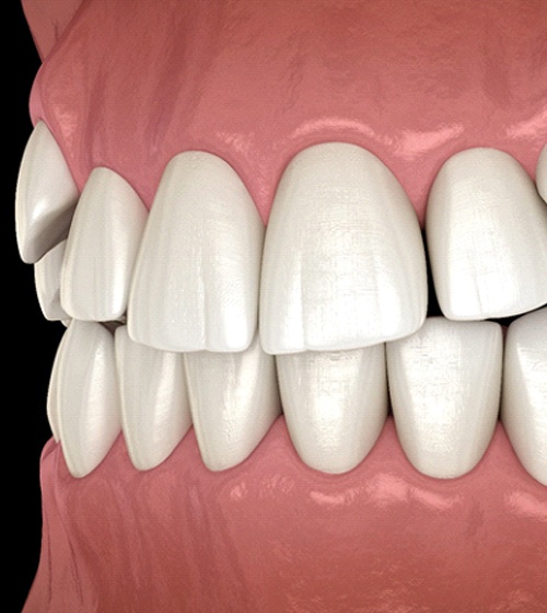 A digital image of crowded teeth located along the top arch of teeth