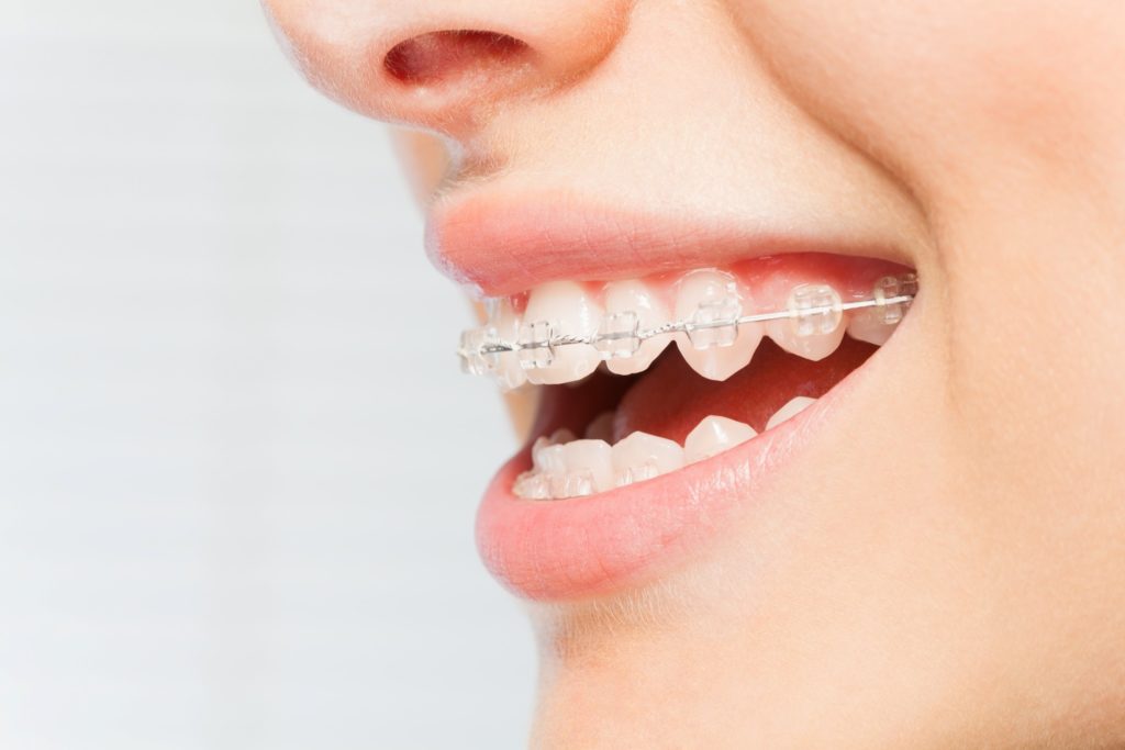 Closeup of woman smiling with metal braces