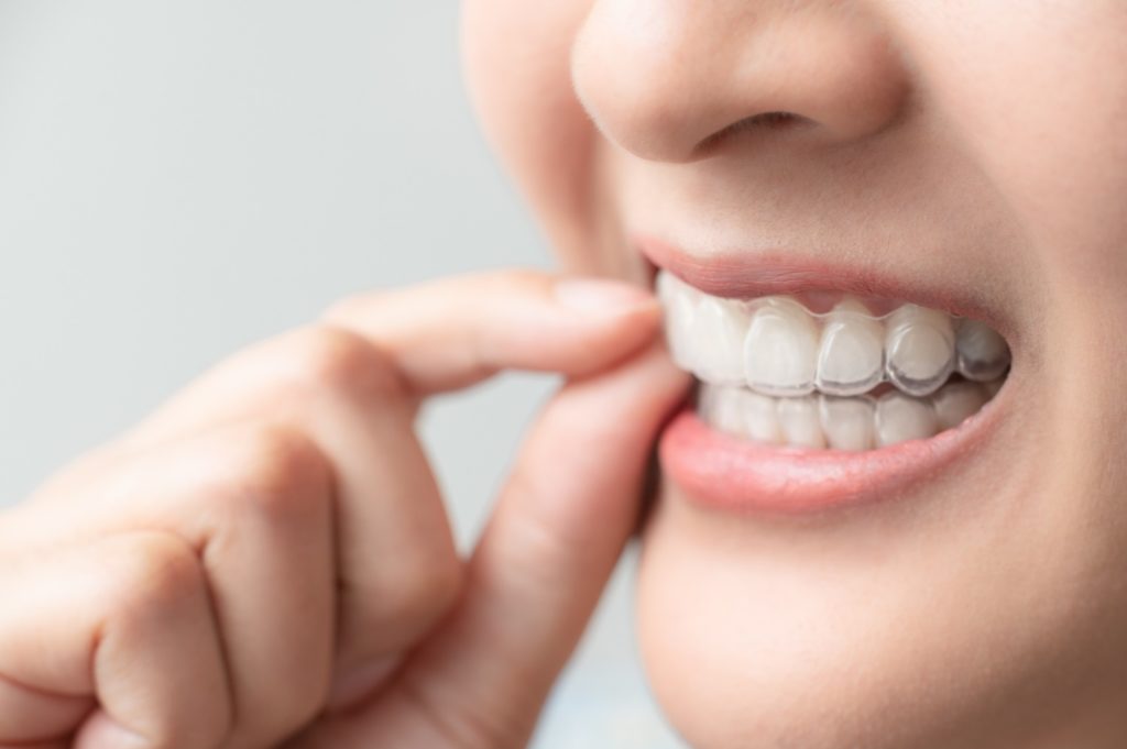 Closeup of woman putting on new clear aligner