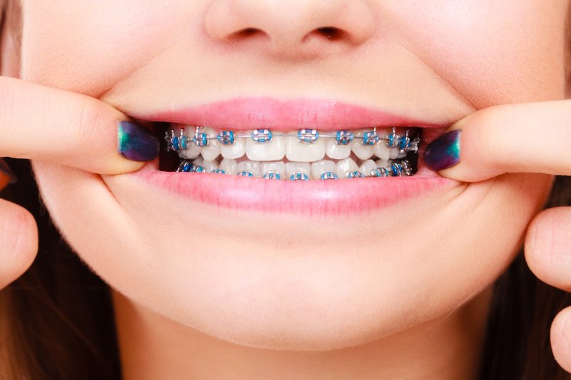 person wearing traditional braces