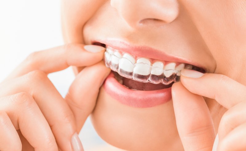 Woman putting clear aligners in her mouth