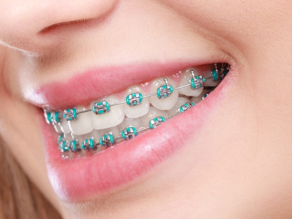 Dental patient wearing metal braces