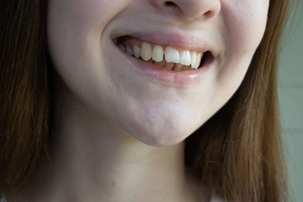 Nose-to-neck of woman with severe overbite smiling