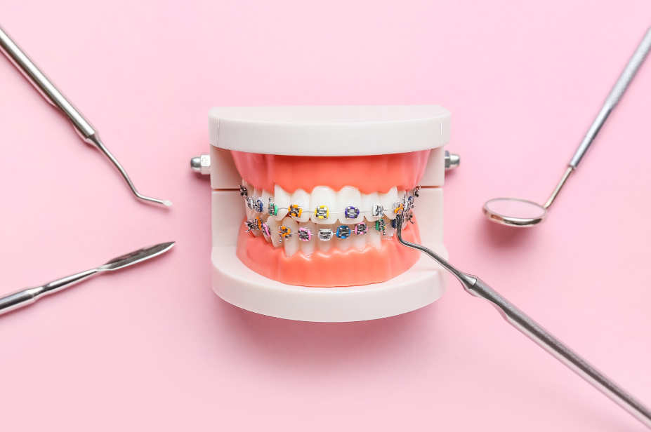 Model braces